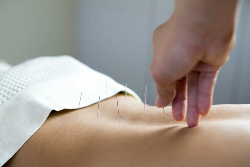 Close-up of a practitioner’s hand gently placing acupuncture needles on a patient’s body during a stress-relief session