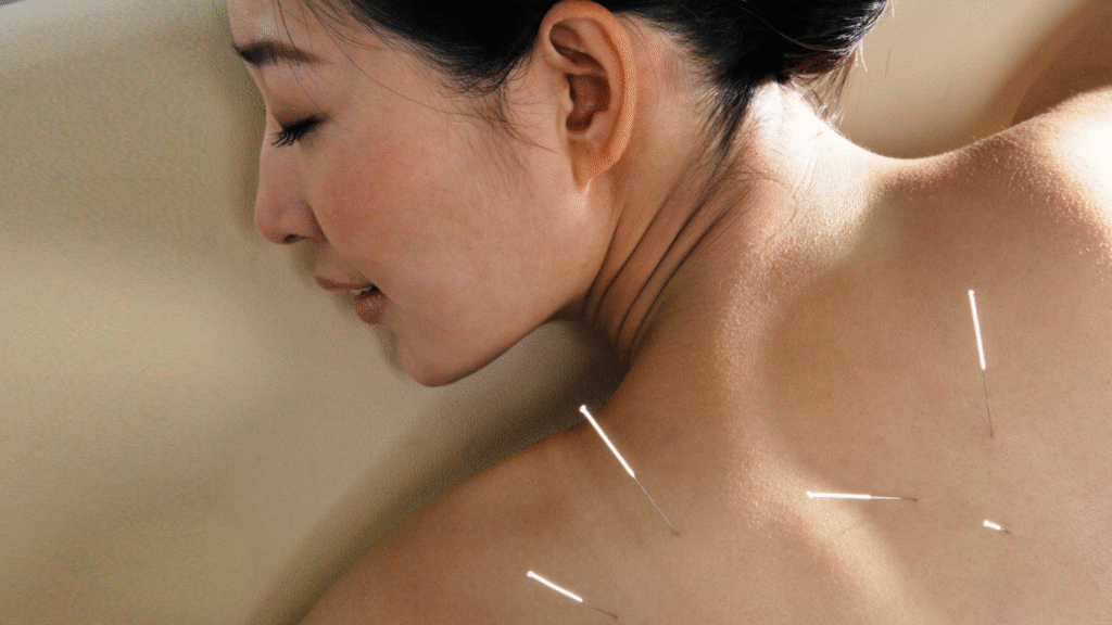 A person resting comfortably while receiving acupuncture, with fine needles placed along the upper back in a calm treatment setting.